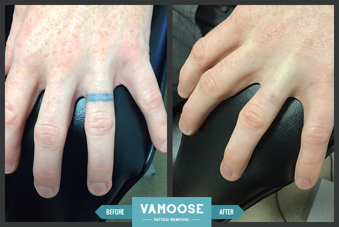 ring finger tattoo before and after